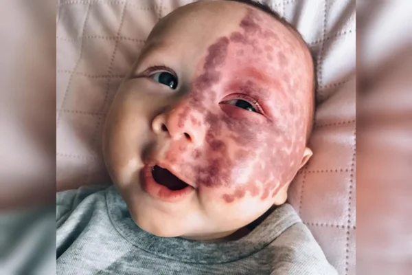 Foto em close-up mostra bebê com uma mancha arrocheada ao redor do rosto - Metrópoles