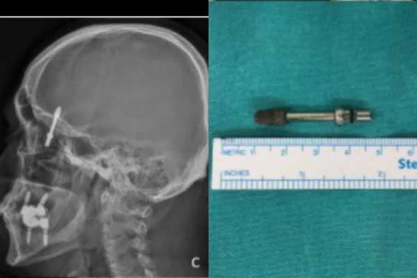 Reprodução mostra exames de imagem feitos que revelam parafuso de implante dentário no cérebro de paciente - Metrópoles