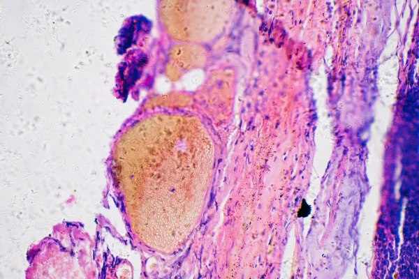 Imagem de microscópio mostra um câncer de pele do tipo melanoma - Metrópoles