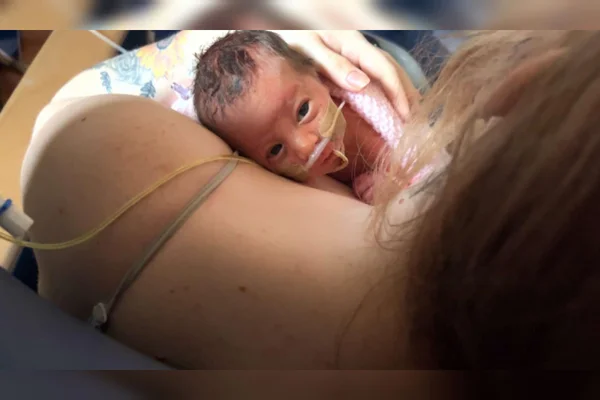 Foto mostra bebê recém-nascida no colo da mãe. Ela teve gastrosquise, má-formação de saúde que faz os órgãos "vazarem" do corpo - Metrópoles
