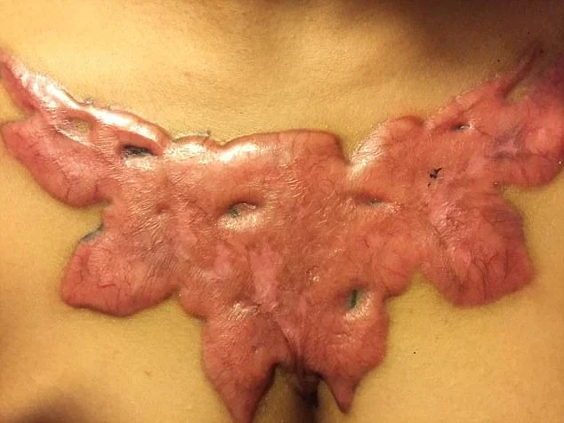 Garota relata momentos de dor ao remover tatuagem com método polêmico - imagem 12 Garota relata momentos de dor ao remover tatuagem com método polêmico - imagem 12
