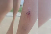 Ferimentos causados pelo rojão acendido pelos jovens