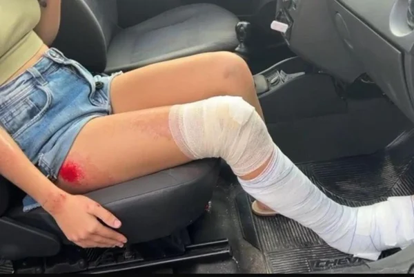 Foto colorida de machucados que a jovem sofreu - Metrópoles