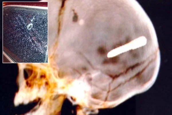 Homem se apresenta à polícia após morte de bebê atingido por prego