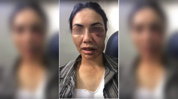 Marcia Angola teve o rosto desfigurado