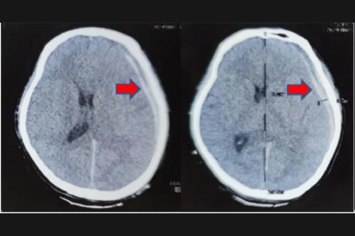 Os médicos encontraram um hematoma subdural do lado esquerdo (seta) do cérebro do paciente Os médicos encontraram um hematoma subdural do lado esquerdo (seta) do cérebro do paciente