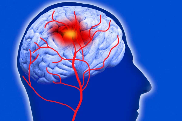 Ilustração dos vasos cerebrais - AVC, Metrópoles - moyamoya