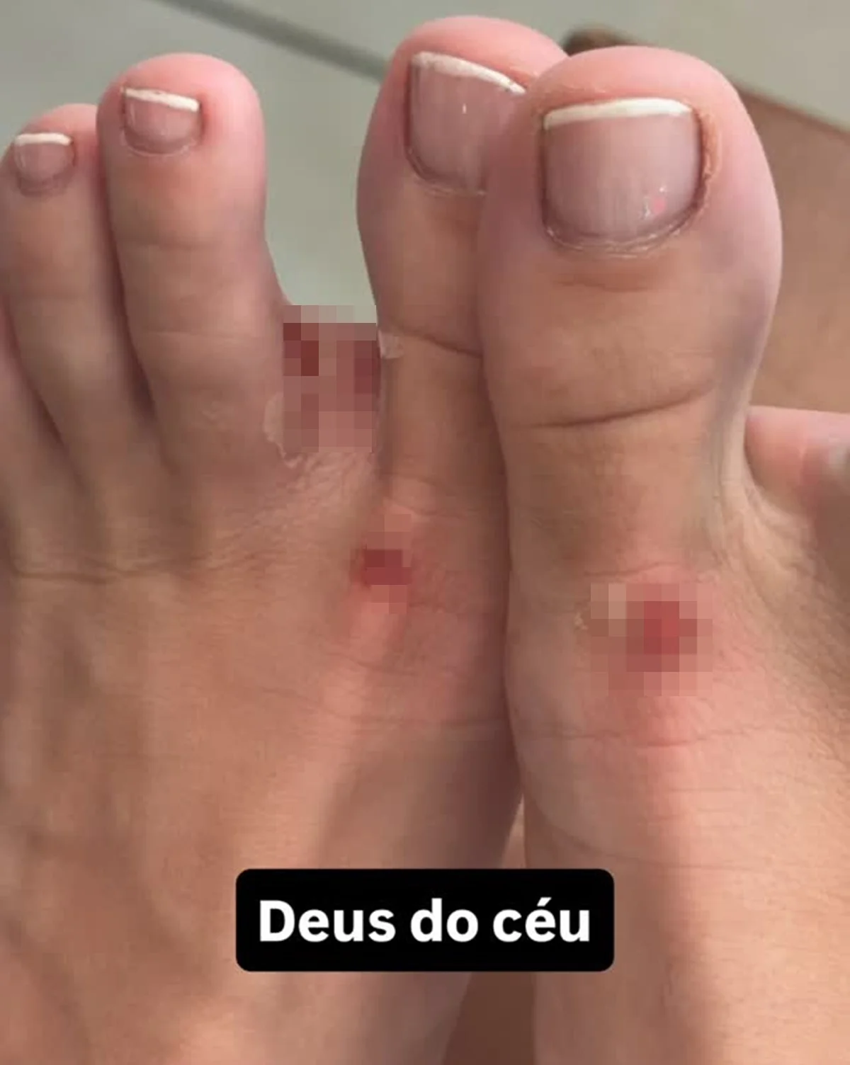Karoline Lima mostra ferimentos nos pés após gravações Karoline Lima mostra ferimentos nos pés após gravações