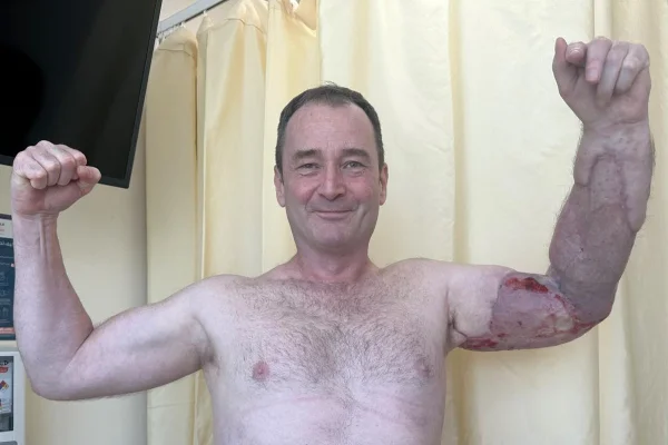 Foto mostra Homem teve bactéria comedora de carne fasciite necrosante após machucado treinando (2)