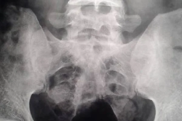 Homem não consegue urinar e médicos acham objeto inusitado na bexiga
