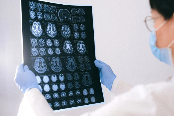 Médico olhando raio-x cerebral. Alzheimer. Metrópoles - declínio cognitivo