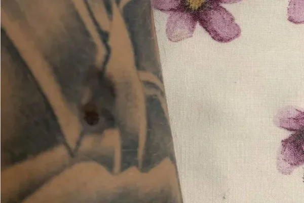 Melanoma