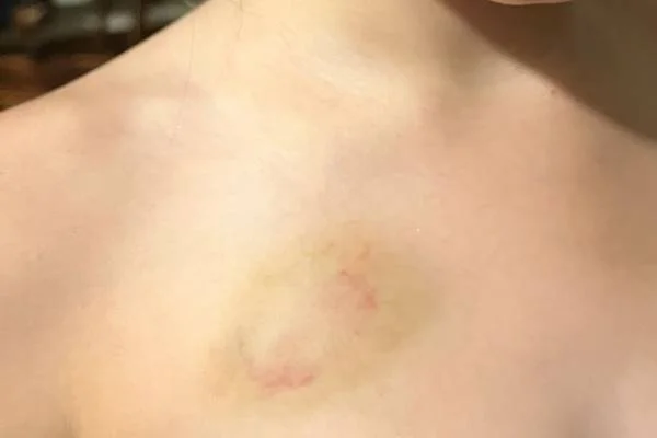 Fotografia colorida de hematoma
