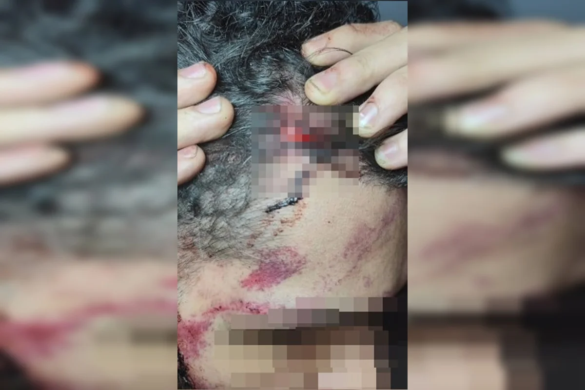 Lesão na cabeça do motorista Lesão na cabeça do motorista