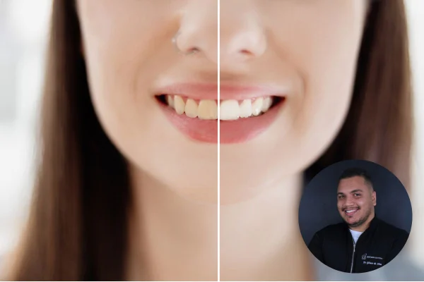 Clareamento dental dr Gilmar da Silva