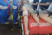 Mulher foi golpeada na perna pelo companheiro Mulher foi golpeada na perna pelo companheiro