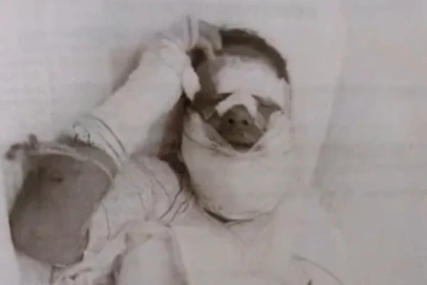 Imagem preto e branca de uma mulher com o rosto enfaixado. Metrópoles