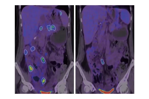 Novo tratamento engana o corpo para atacar o câncer, sugere estudo