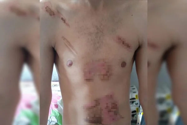 Jovem é torturado, queimado com ferro e chapinha de cabelo por mulher