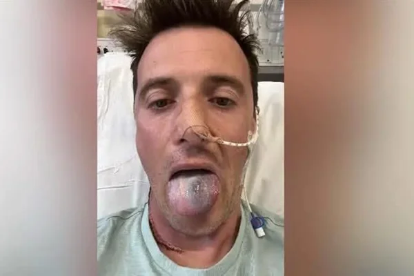 foto colorido de homem com a língua para fora, mostrando uma área escurecida do órgãos. - Metrópoles.