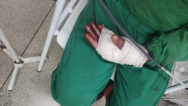 Homem quase tem mão decepada após explodir rojão para espantar araras