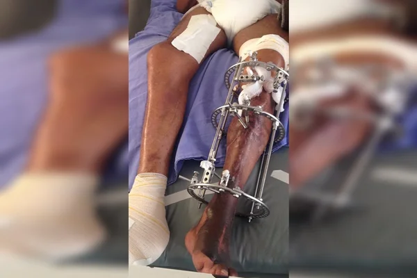 Pé de paciente apodrece enquanto ele aguarda vaga para cirurgia no HRT