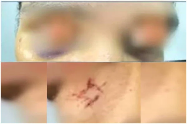 Homem mantido em cárcere mostra lesões pelo corpo