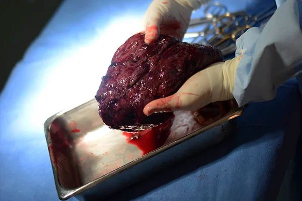 Vale a pena guardar a placenta para consumi-la no pós-parto?