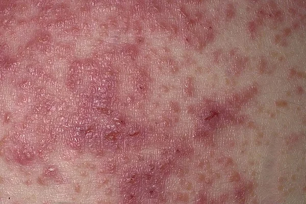 Mulher com eczema é impedida de embarcar após suspeita de monkeypox