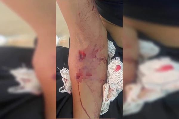 Imagens fortes: veja lesões de mulher atacada por seis cães de rua