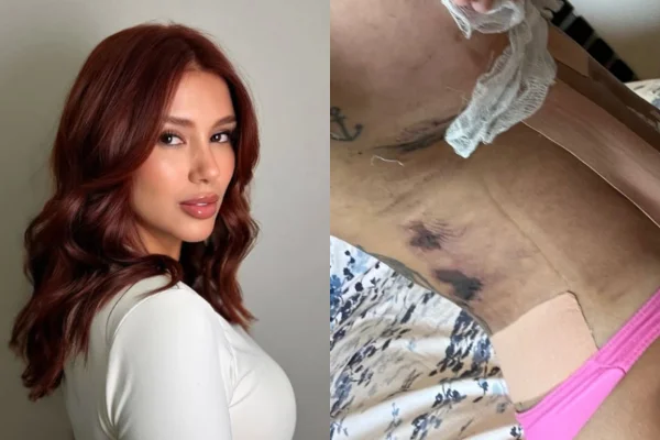 Influencer acusa clínica estética de “deformar” seu corpo após lipo