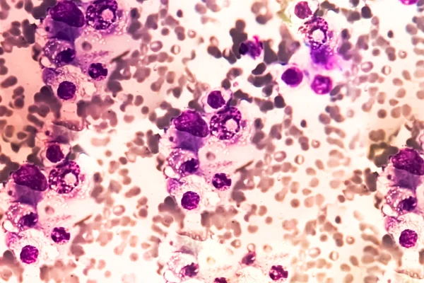 Imagem de microscópio mostra células do sangue e da medula óssea com mieloma múltiplo, um tipo de câncer no sangue - Metrópoles