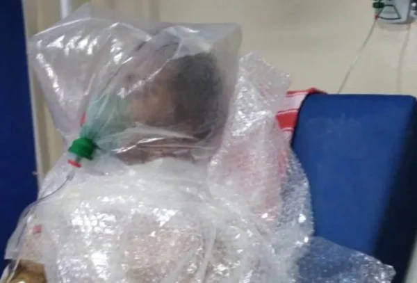 paciente enrolado em saco plastico, no Amazonas, que funciona como um respirador