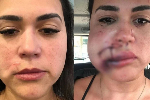 Mulher agredida mostrando suas cicatrizes após o ocorrido
