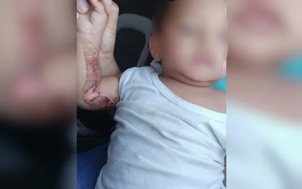goias bebe é resgatado dos pais após sofrer queimadura com carvao de narguile