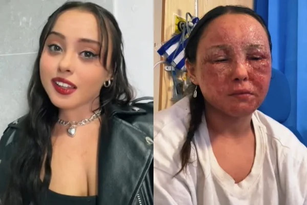 Montagem de fotos mostra o rosto de Beatrice Gaucahas com a crise de eczema e depois do tratamento