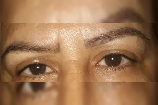 Erro de esteticista deixa marcas na pele de cliente em Campo Grande