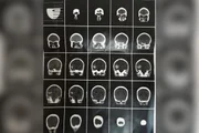 Após o golpe, vítima teve dores de cabeça e passou por exame que constatou lesão intracraniana Após o golpe, vítima teve dores de cabeça e passou por exame que constatou lesão intracraniana