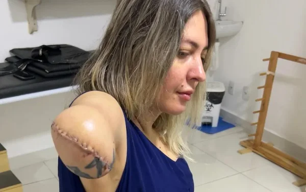 goias tatuadora braço amputado apos lipo