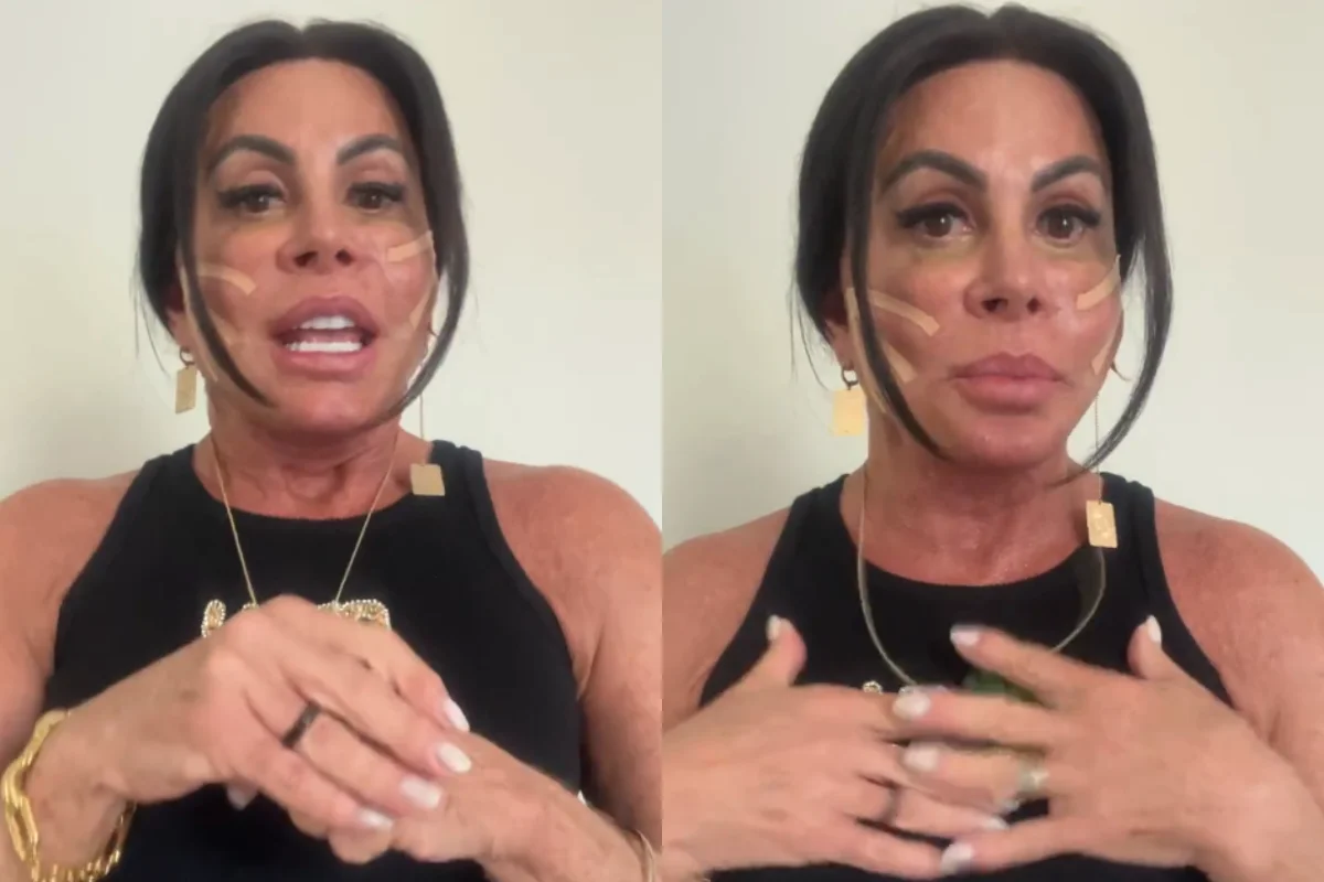 Gretchen aplica fios de sustentação no rosto: médica explica técnica e efeitos