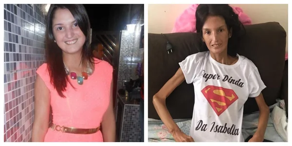 Jovem que chegou a pesar 34 kg por causa de doença rara morre após 8 anos