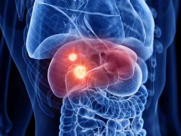 Ilustração do raio-x de um figado com tumor- Metrópoles