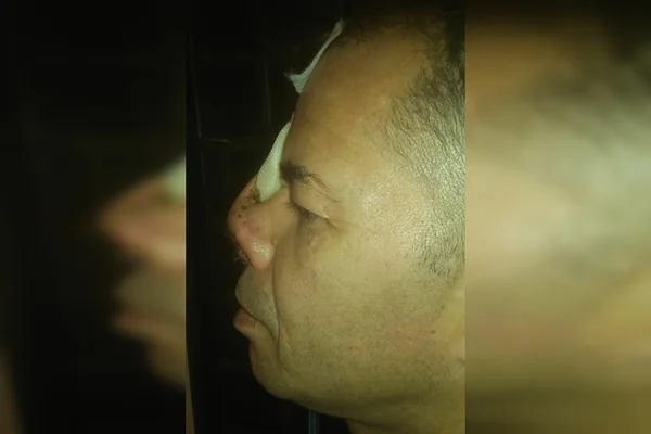 Perfil de rosto de homem com nariz deformado e curativos no rosto