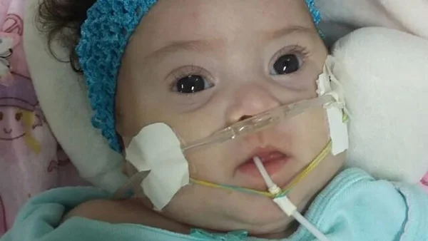 Após petição, GDF libera cirurgia de bebê com síndrome de Down