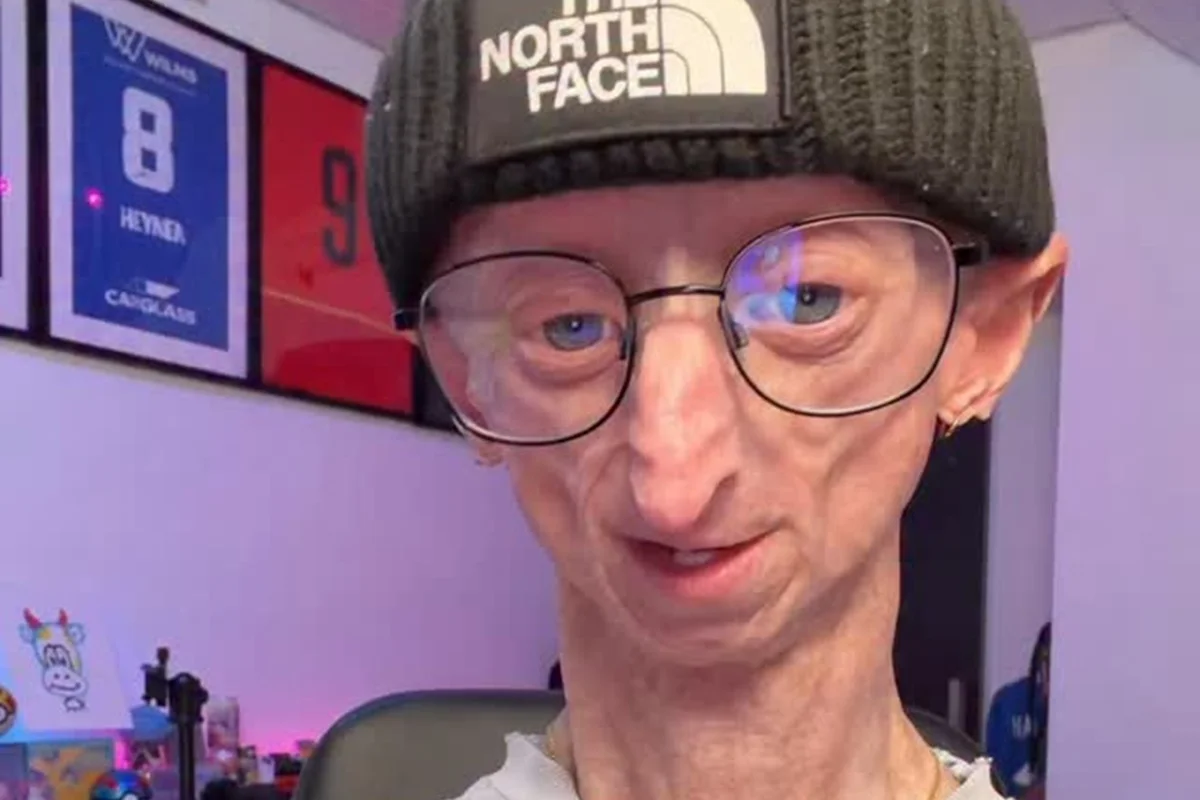 Michiel Vandeweert compartilhava sua rotina com a doença rara nas redes sociais Michiel Vandeweert compartilhava sua rotina com a doença rara nas redes sociais