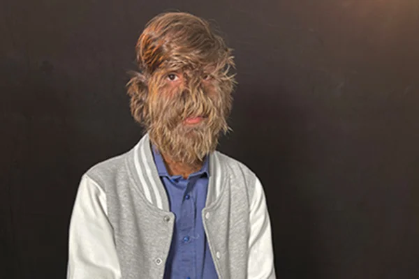 Imagem colorida do homem mais peludo do mundo - Metrópoles