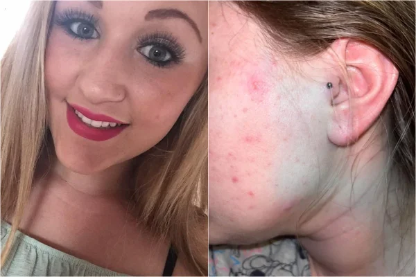 “Meu rosto ficou azul”, diz jovem após colocar piercing na orelha