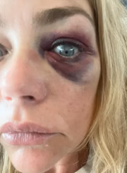 Denise Richards anexou fotos das marcas deixadas pela agressão do ex