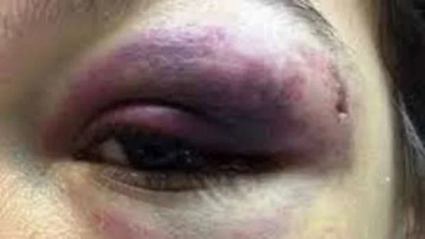 Mulher é agredida com socos e chutes e tem rosto desfigurado