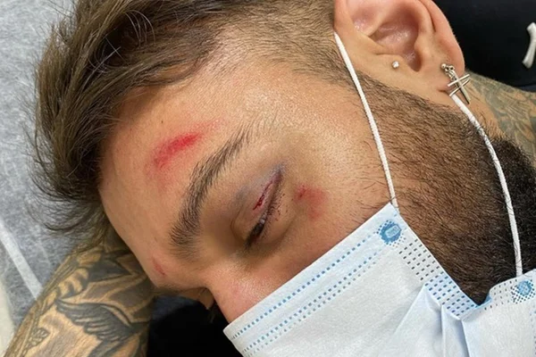 Lucas Lucco vai para o hospital com hematomas no rosto após queda